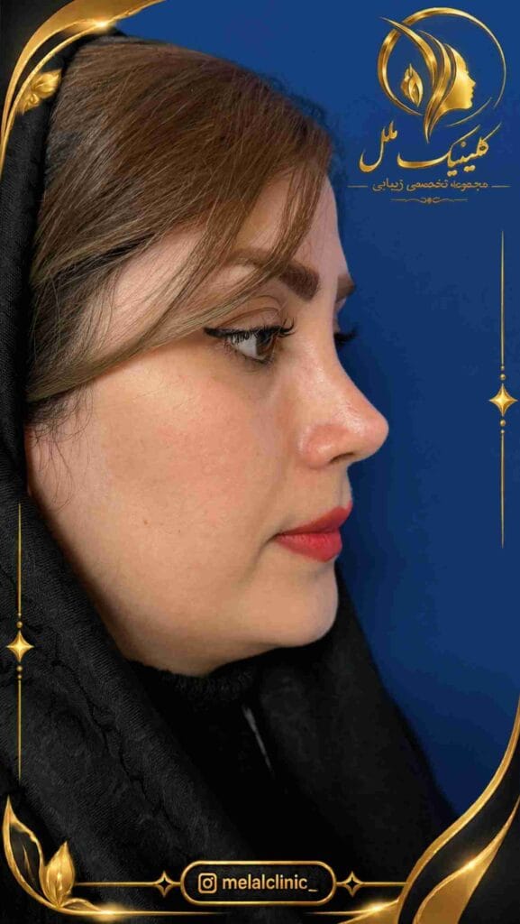 بعد از رینوپلاستی – نمای روبهرو، کاهش عرض ظاهری بینی و فرم نرم نوک