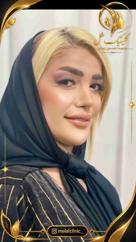 نتیجه عمل بینی – ۶ ماه پس از جراحی، نمای نیمرخ چپ، پروفایل متعادل بینی