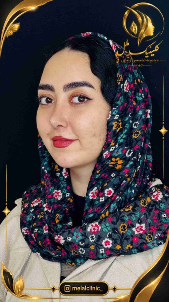 بعد از جراحی بینی – نمای سهرخ راست، خط طبیعی پشت بینی و تیپ متناسب