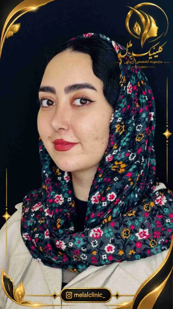بعد از جراحی بینی &ndash; نمای سه&zwnj;رخ راست، خط طبیعی پشت بینی و تیپ متناسب
