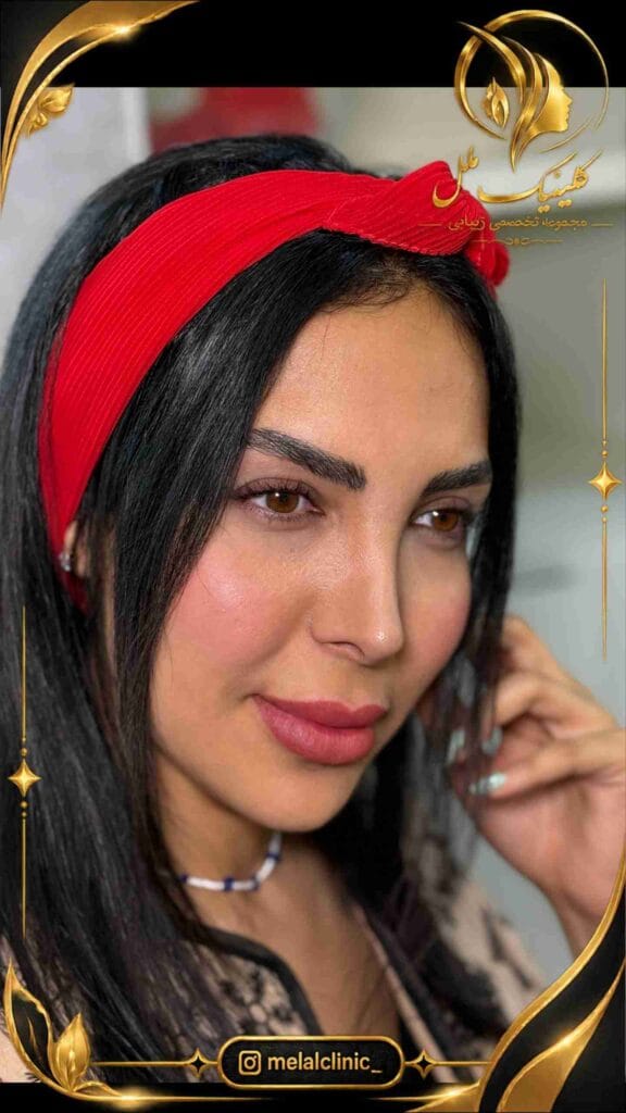 نتیجه جراحی زیبایی بینی بیش از ۶ ماه پس از عمل – نمای سهرخ، اصلاح فرم پل بینی