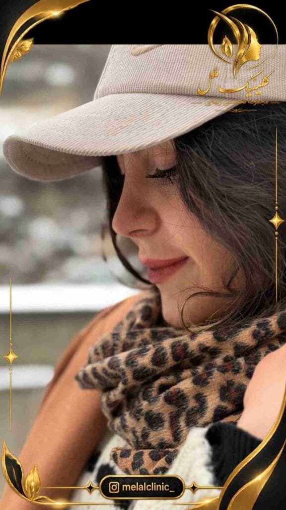 نتیجه عمل بینی ۸ ماه پس از جراحی &ndash; نمای نیم&zwnj;رخ راست، کاهش قوز و پل بینی صاف&zwnj;تر