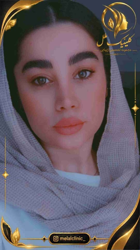 نتیجه عمل بینی بیش از ۶ ماه پس از جراحی – نمای نیمرخ، خط پشت بینی یکنواخت