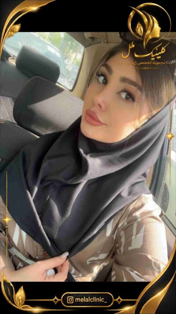 بعد از جراحی بینی – نمای سهرخ، چرخش ملایم نوک بینی و تناسب کلوملا