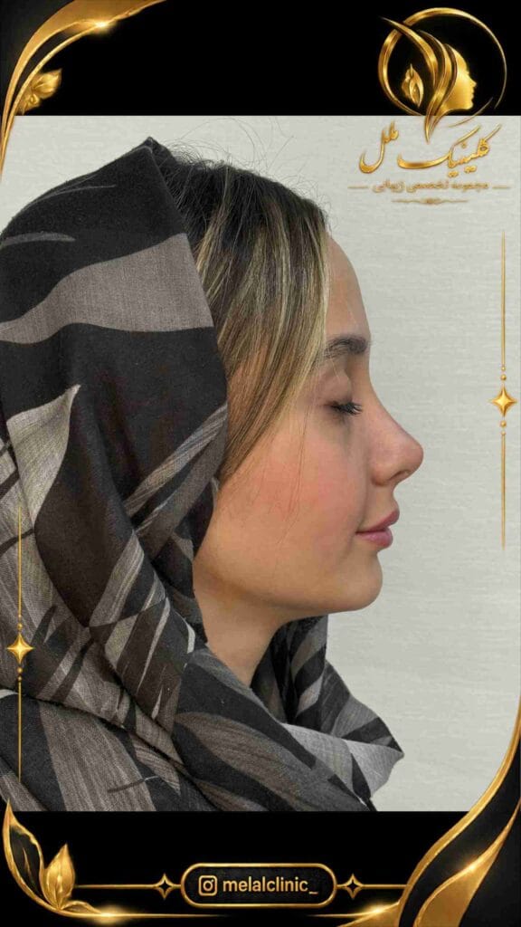 نتیجه رینوپلاستی ۱۰ ماه پس از عمل – نمای روبهرو، کاهش پهنای ظاهری پل بینی