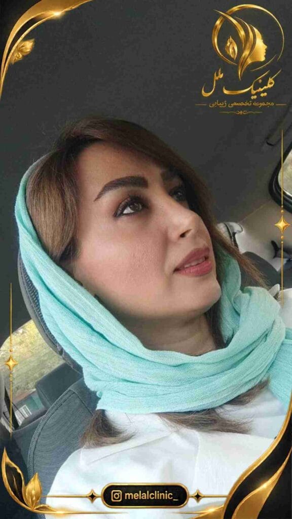 بعد از عمل بینی – نمای نیمرخ چپ، فرم طبیعی بینی پس از اصلاح ساختار پل