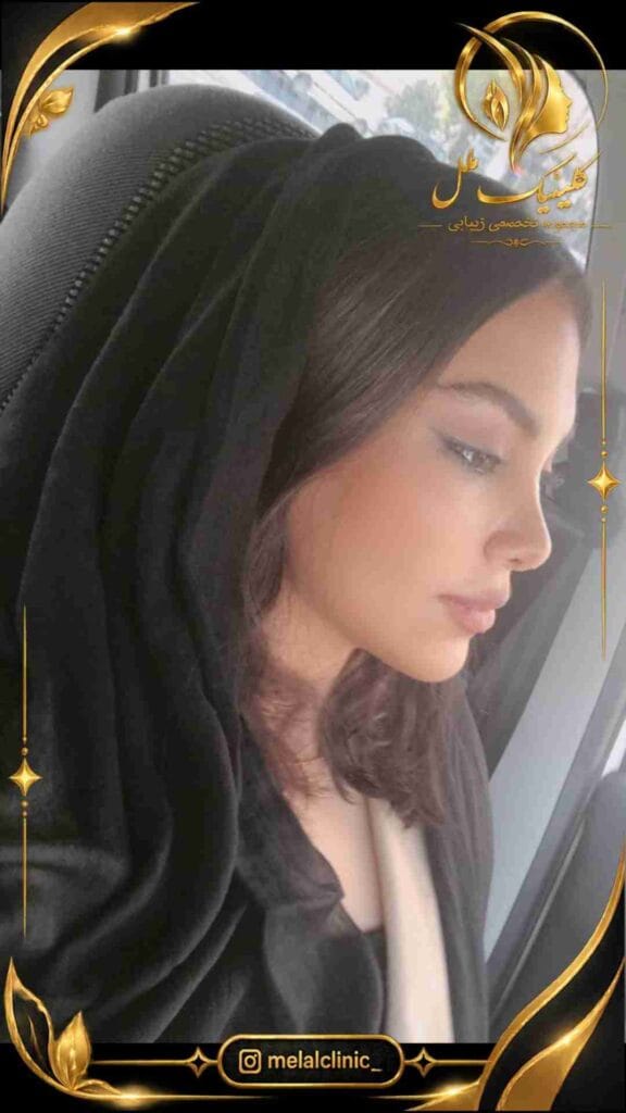 نتیجه عمل زیبایی بینی یک سال پس از جراحی – نمای نیمرخ، پروفایل صاف و طبیعی بینی
