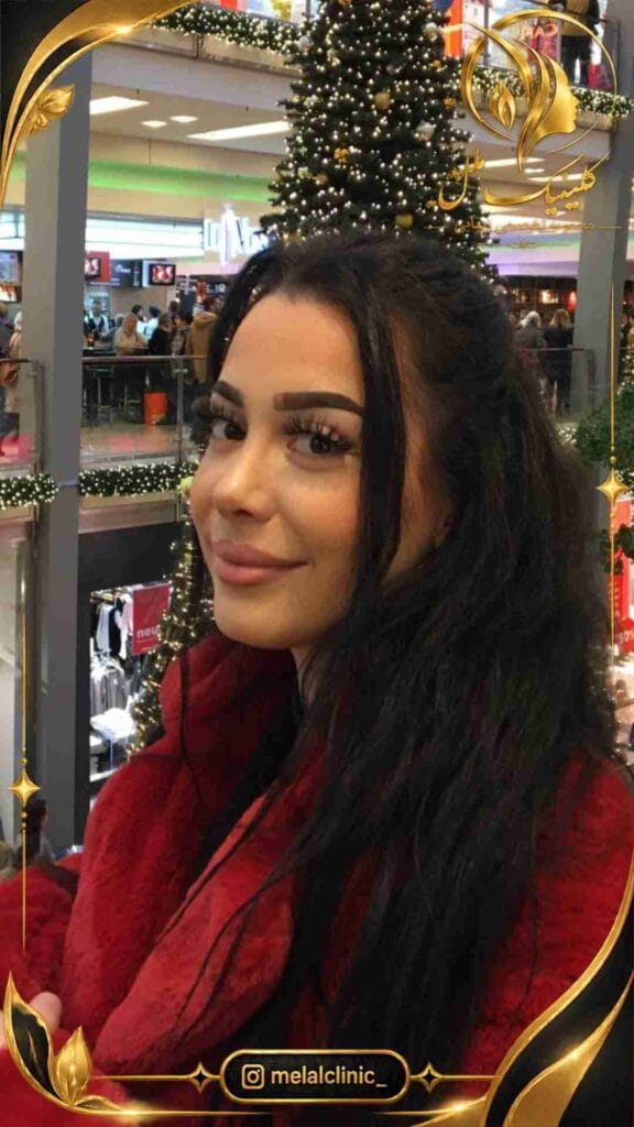 بعد از عمل بینی طبیعی – نمای نیمرخ راست، حفظ هویت چهره با فرم متعادل بینی