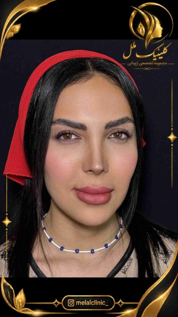 نتیجه عمل بینی بیش از ۶ ماه پس از جراحی – نمای نیمرخ، زاویه طبیعی نوک بینی