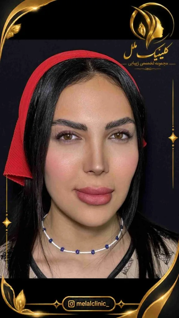 نتیجه عمل بینی بیش از ۶ ماه پس از جراحی &ndash; نمای نیم&zwnj;رخ، زاویه طبیعی نوک بینی