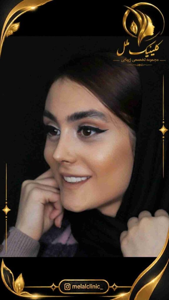 نتیجه رینوپلاستی ۹ ماه پس از عمل – نمای روبهرو، فرم طبیعی و متناسب بینی