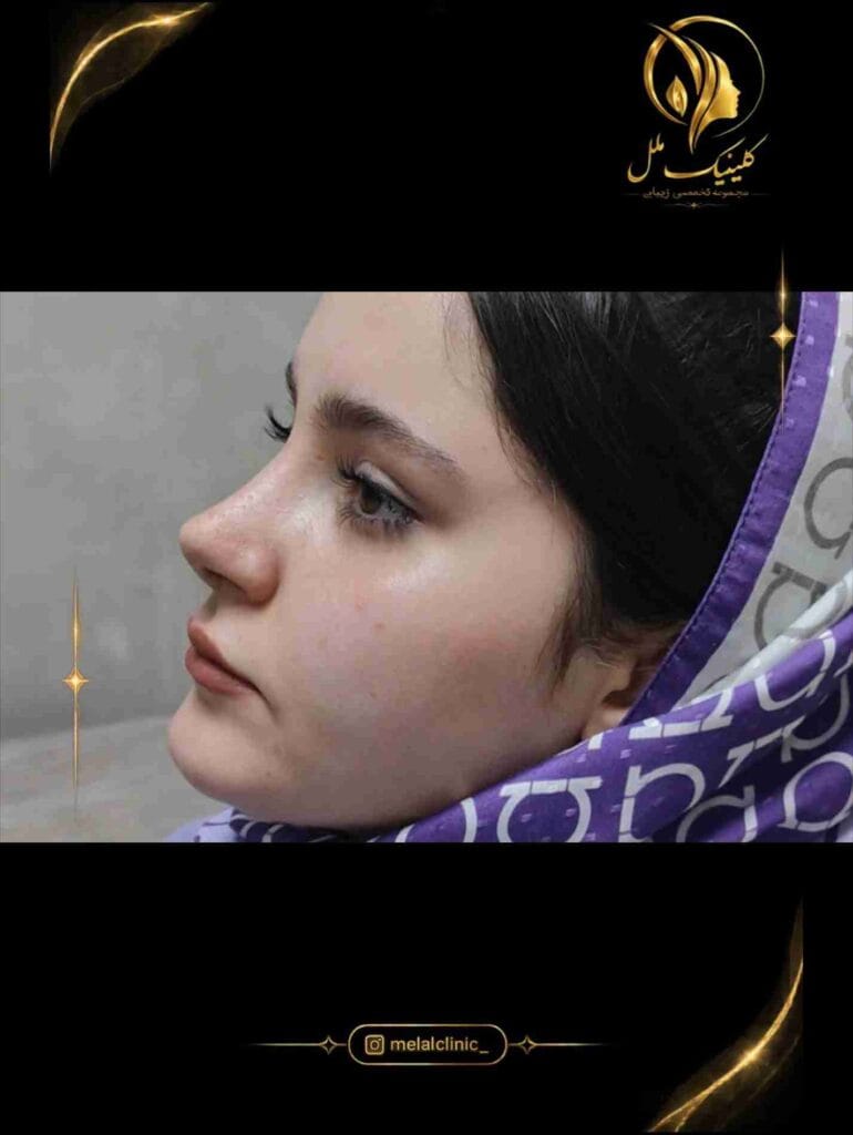 نتیجه جراحی بینی بیش از ۶ ماه پس از عمل &ndash; نمای سه&zwnj;رخ راست، هماهنگی کلوملا و تیپ بینی