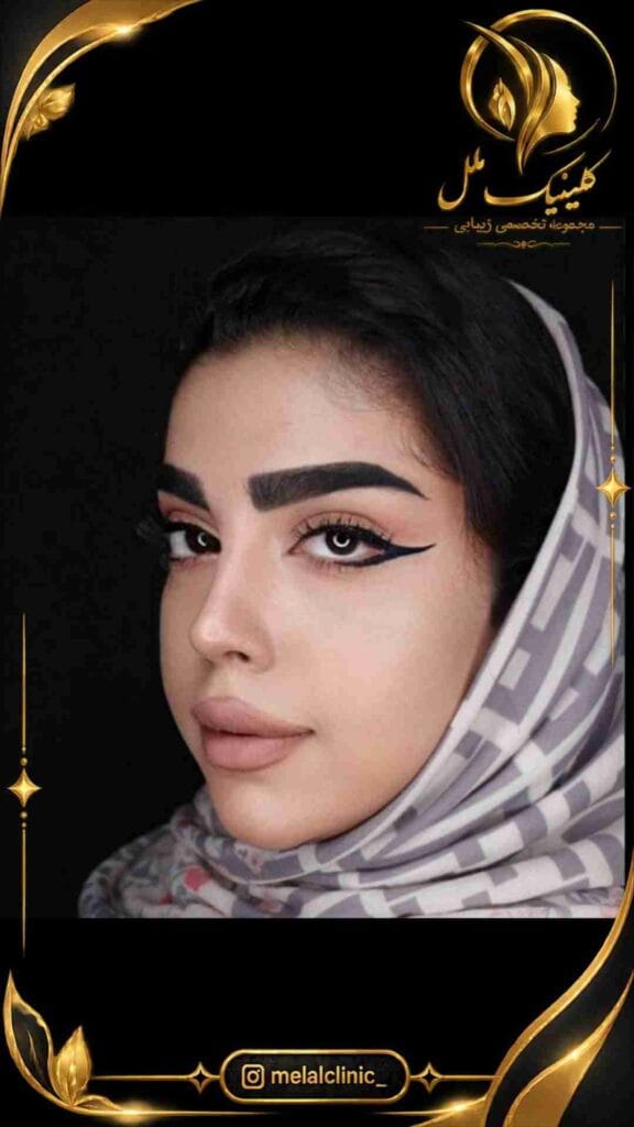 نتیجه عمل بینی یک سال پس از جراحی – نمای نیمرخ چپ، خط پشت بینی نرم و یکنواخت