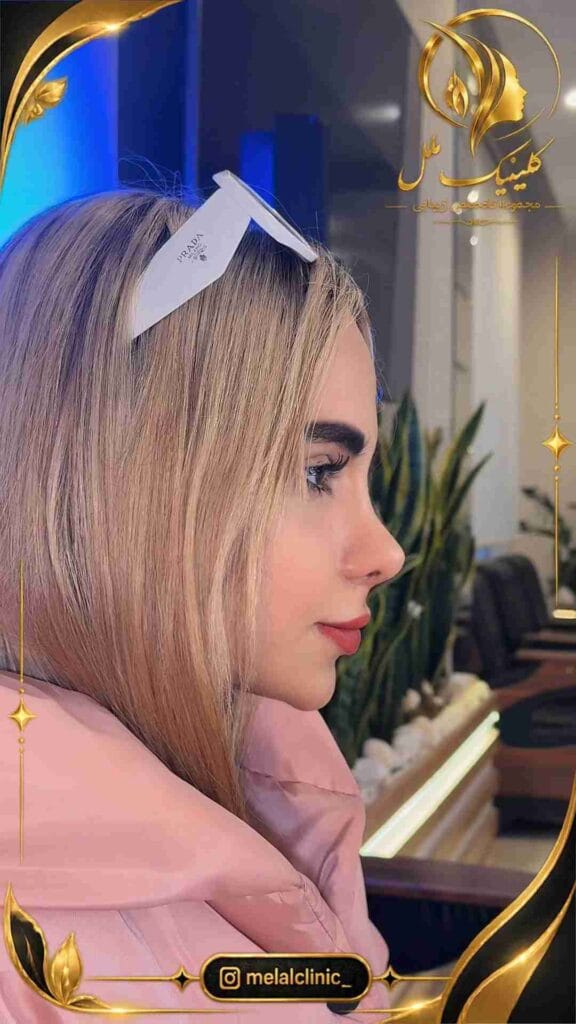 بعد از جراحی بینی – نمای سهرخ، ظاهر متناسب تیپ بینی در کنار اجزای صورت