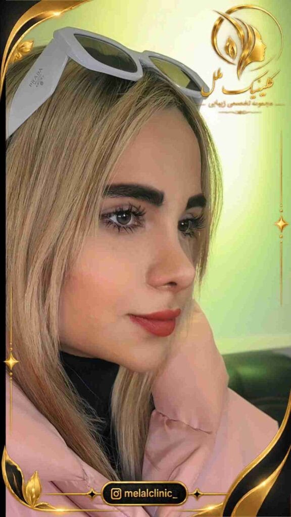 نتیجه رینوپلاستی بیش از ۶ ماه پس از عمل &ndash; نمای روبه&zwnj;رو، فرم طبیعی نوک و پره&zwnj;های بینی