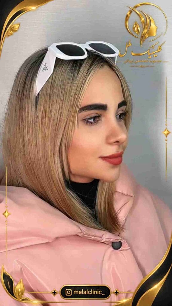 نتیجه جراحی بینی ۸ ماه پس از عمل – نمای سهرخ، پل بینی متناسب و نوک با چرخش ملایم
