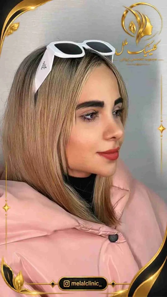 نتیجه جراحی بینی ۸ ماه پس از عمل &ndash; نمای سه&zwnj;رخ، پل بینی متناسب و نوک با چرخش ملایم