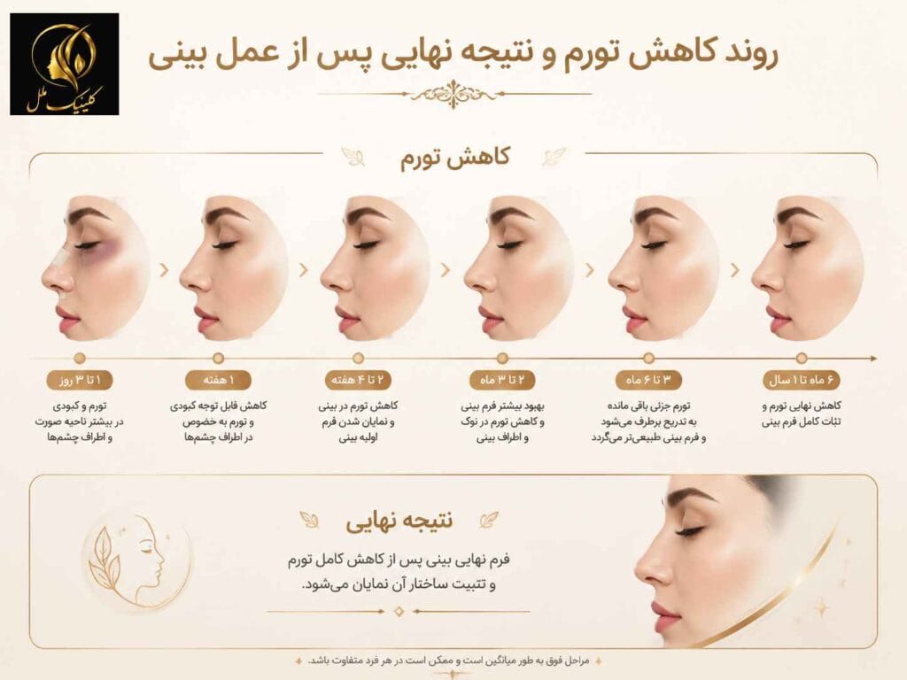مراحل کلی کاهش تورم و شکل&zwnj;گیری نتیجه پس از عمل بینی