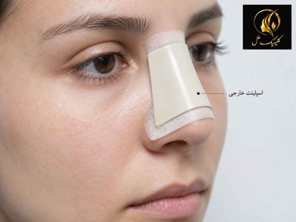 اسپلینت خارجی بینی در روزهای ابتدایی پس از رینوپلاستی