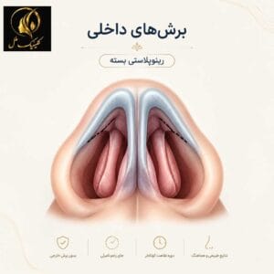 نمای آموزشی برش&zwnj;های داخلی بینی در رینوپلاستی بسته