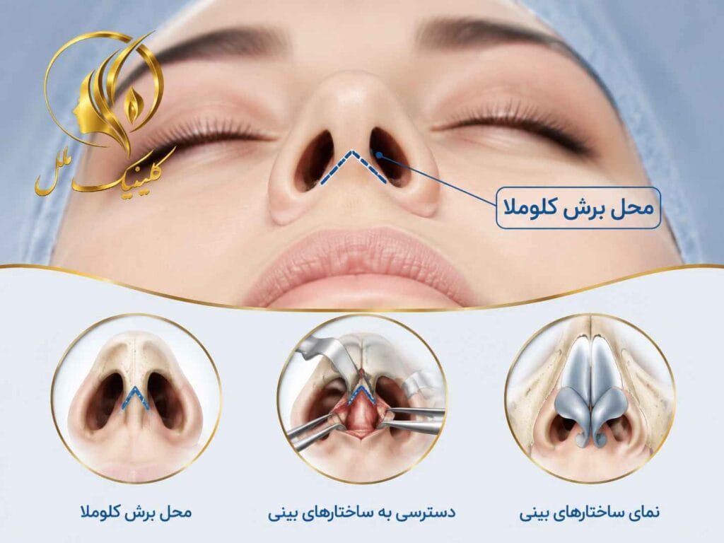 نمای آموزشی محل برش کلوملا در روش باز رینوپلاستی