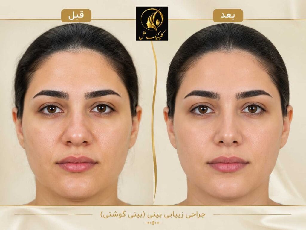 نمونه نتیجه عمل بینی گوشتی قبل و پس از جراحی در نمای روبه&zwnj;رو