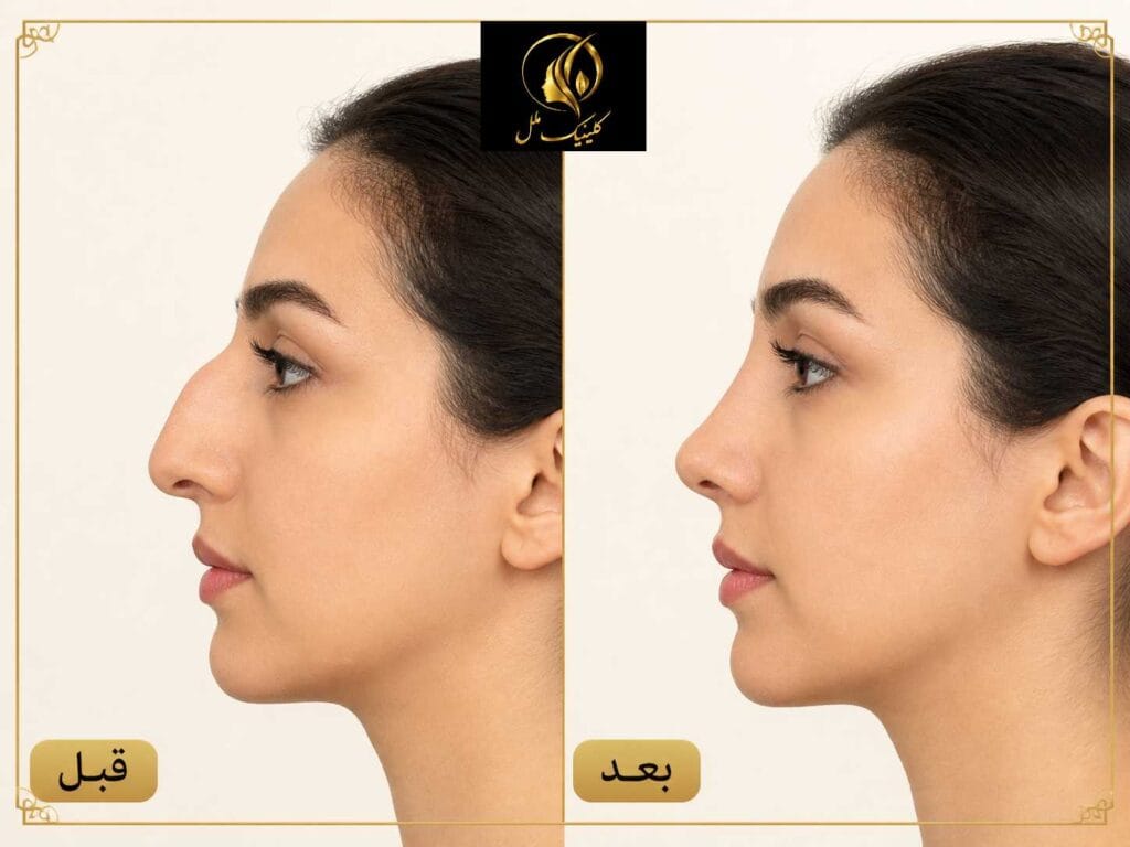 نتیجه عمل بینی استخوانی قبل و بعد از جراحی در نمای نیم&zwnj;رخ