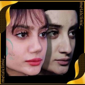 نتیجه عمل بینی زنانه، نمای سه&zwnj; رخ، ۶ ماه پس از عمل