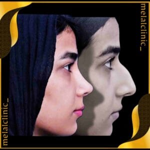 نمونه کار جراحی بینی زنانه، نمای سه&zwnj; رخ، ۶ ماه پس از عمل