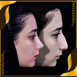 نتیجه عمل بینی زنانه، نمای نیم&zwnj; رخ، ۶ ماه پس از عمل