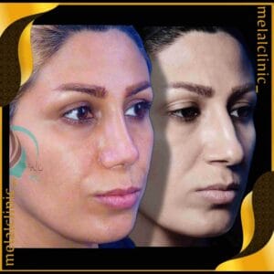 عکس قبل و بعد عمل بینی زنانه، نمای سه&zwnj; رخ، ۶ ماه پس از عمل