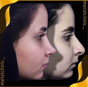 نمونه کار جراحی بینی زنانه، نمای سه&zwnj; رخ، ۶ ماه پس از عمل