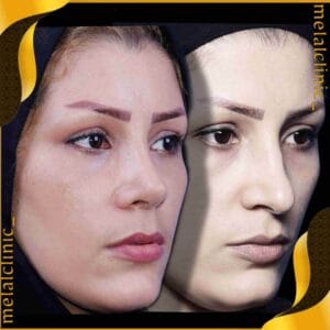 نتیجه عمل بینی زنانه، نمای نیم&zwnj; رخ، ۶ ماه پس از عمل