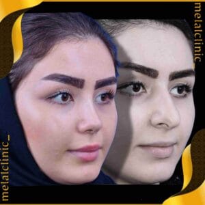 نتیجه عمل بینی زنانه، نمای سه رخ، ۶ ماه پس از عمل