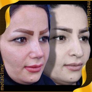 نتیجه عمل بینی زنانه، نمای نیم رخ، ۶ ماه پس از عمل