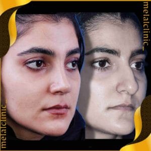 نمونه کار جراحی بینی زنانه، نمای سه رخ، ۶ ماه پس از عمل