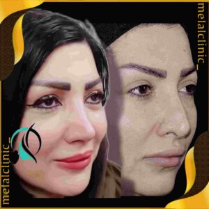 نمونه کار جراحی بینی زنانه، نمای نیم رخ، ۶ ماه پس از عمل