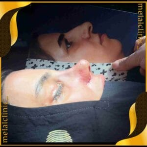 جراحی بینی بسته، تصویر حین عمل، نمای لترال