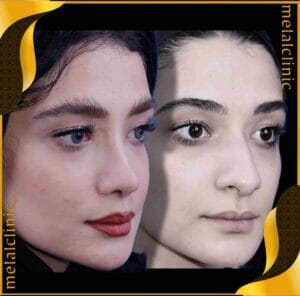 نمونه کار جراحی بینی زنانه جوان، نمای سه رخ، ۶ ماه پس از عمل