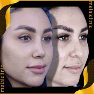 نتیجه عمل بینی زنانه، نمای سه رخ، ۶ ماه پس از عمل