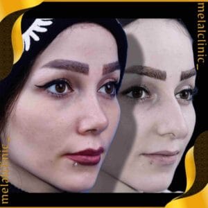 عکس قبل و بعد عمل بینی زنانه، نمای سه رخ، ۶ ماه پس از عمل