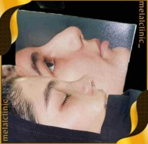 نتیجه عمل بینی، نمای فرونتال، ۶ ماه پس از عمل
