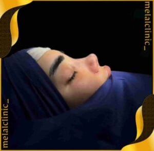 نمونه کار جراحی بینی، نمای سه&zwnj; رخ، ۶ ماه پس از عمل