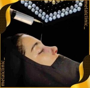 نتیجه عمل بینی، نمای نیمه&zwnj; سه&zwnj; رخ، ۶ ماه پس از جراحی