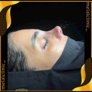 نتیجه رینوپلاستی به سبک پیزوسرجری, نمای نیم رخ بلافاصله بعد از عمل