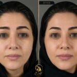 نتیجه واقعی نمونه کار بوتاکس پیشانی قبل و بعد