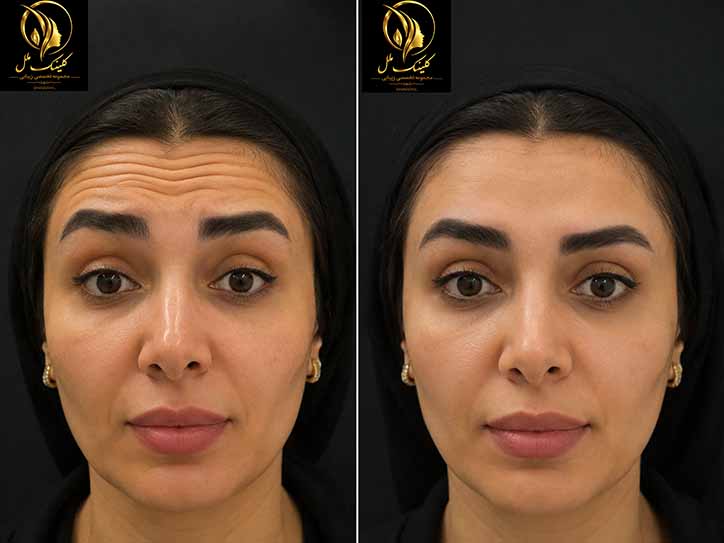 قبل و بعد  تزریق بوتاکس به پیشانی