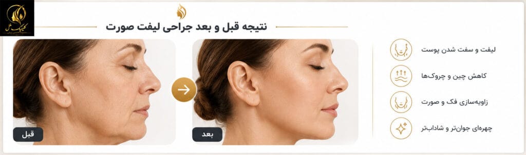 نتیجه قبل و بعد جراحی لیفت صورت