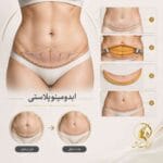 نمای شماتیک عمل ابدومینوپلاستی و اصلاح پوست اضافه شکم