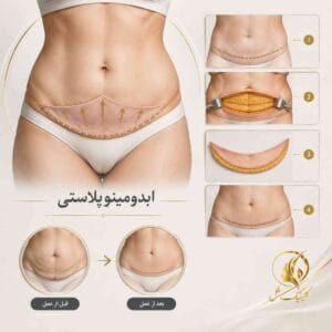 نمای شماتیک عمل ابدومینوپلاستی و اصلاح پوست اضافه شکم